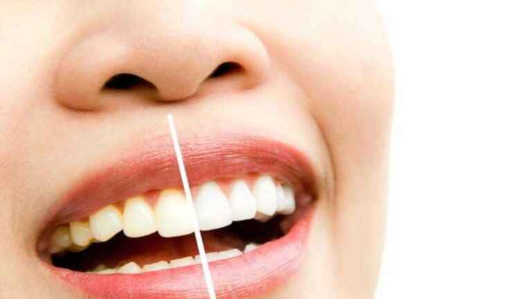Quanto tempo dura um clareamento dental